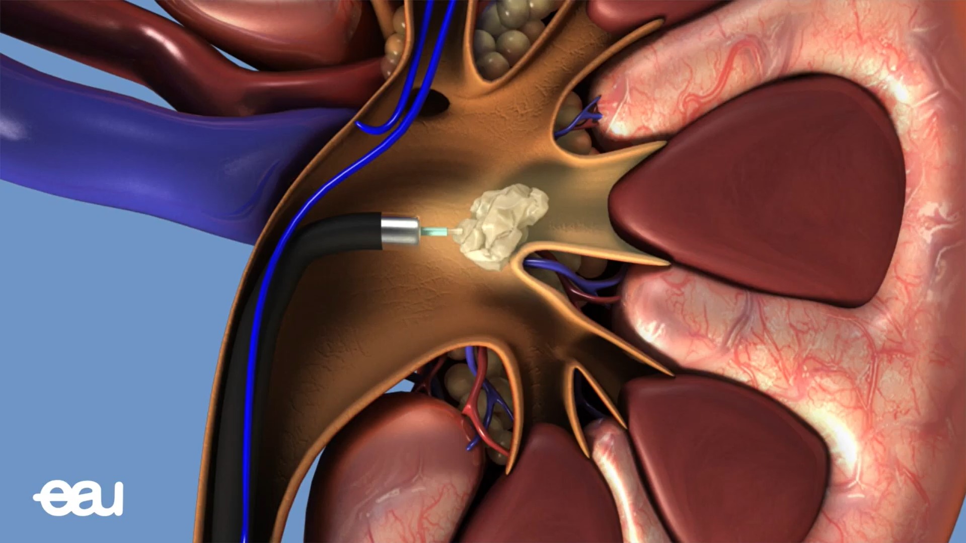 Ουρητηρονεφροσκόπηση