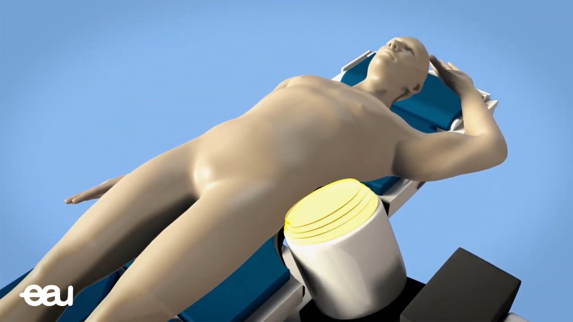 Εξωσωματική Λιθοθρυψία